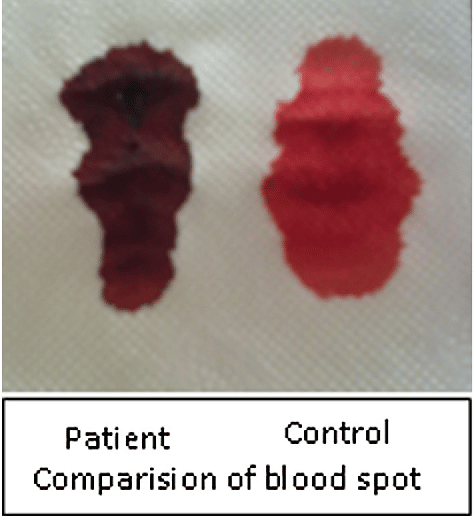 Figure 3 from Methemoglobinemia: Living with Dormant Devil